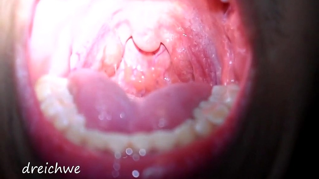 uvula in the patio of my house