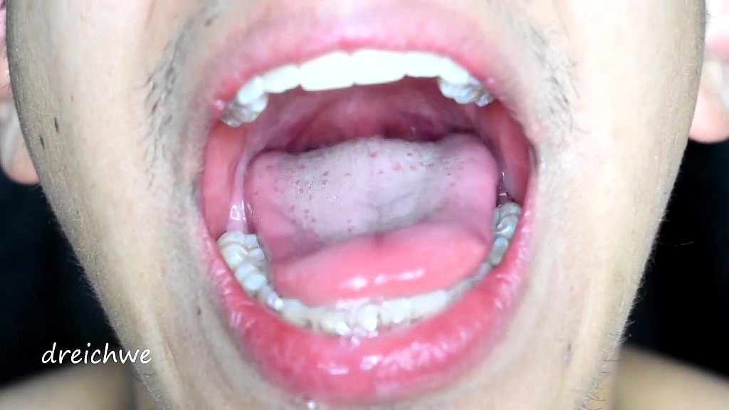 large uvula and hot