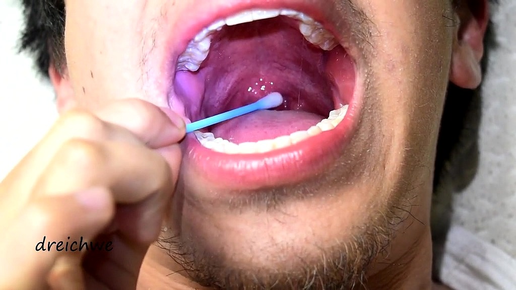 touching the uvula with swabs