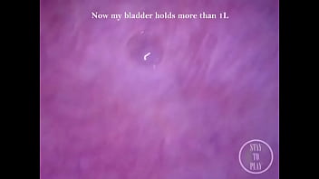 POV Endoscope Catheter Bladder Inflation!